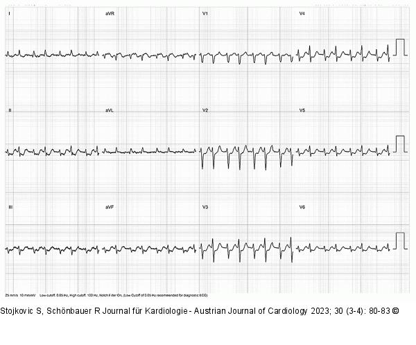 12-Kanal-EKG