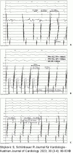 EKG