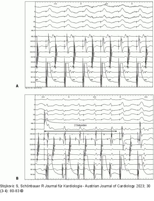 EKG