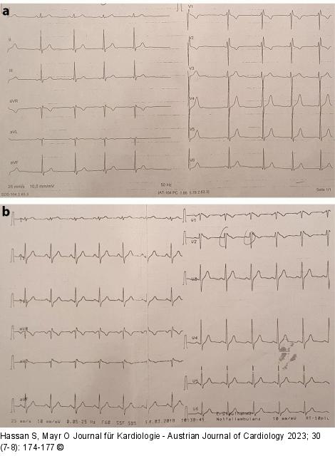 EKG