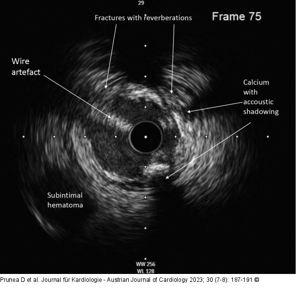 IVUS