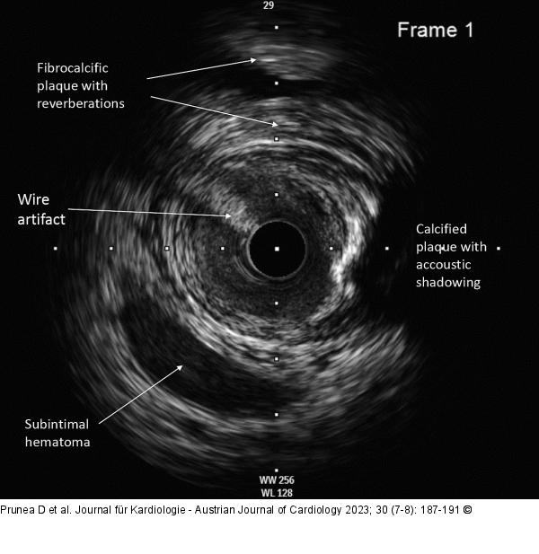 IVUS