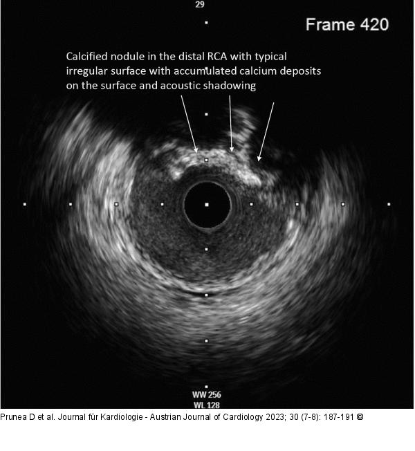 IVUS