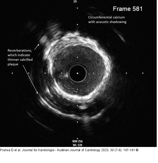 IVUS