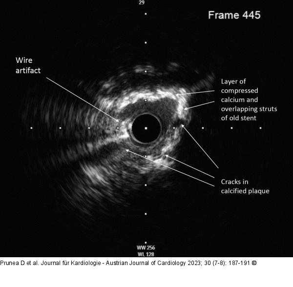 IVUS