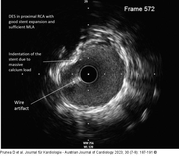 IVUS