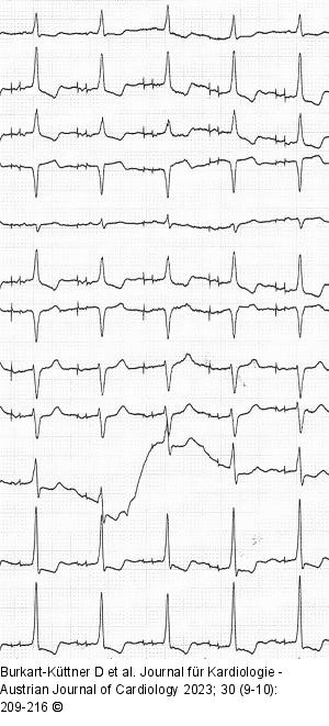 EKG