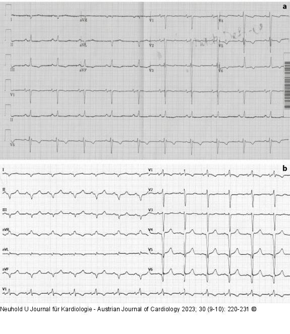 EKG