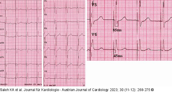 EKG