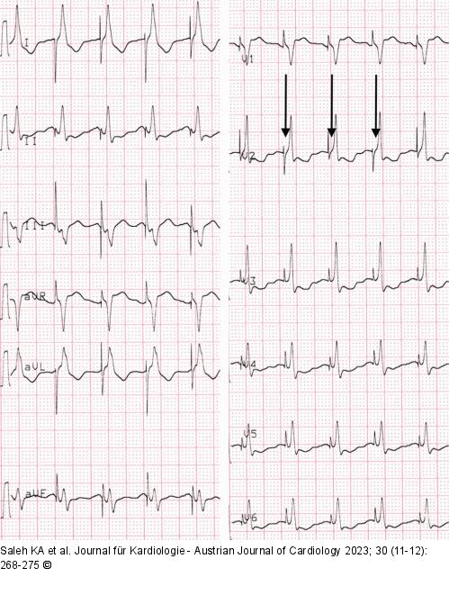 EKG