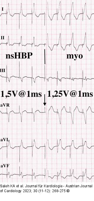 EKG