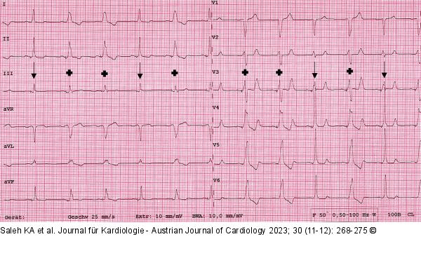 EKG