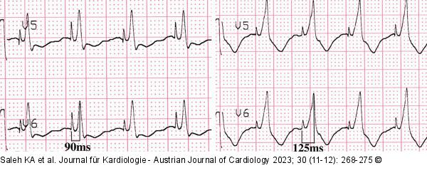 EKG
