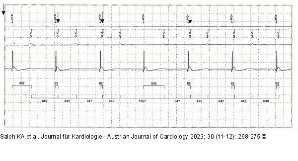 EKG