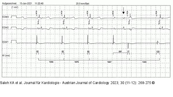 EKG