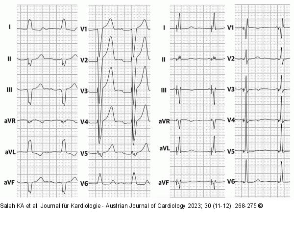 EKG