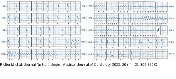 EKG