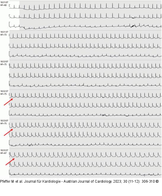 EKG