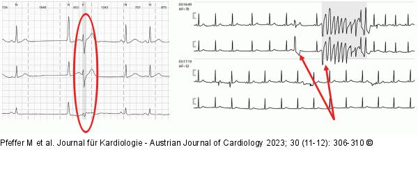 Holter-EKG