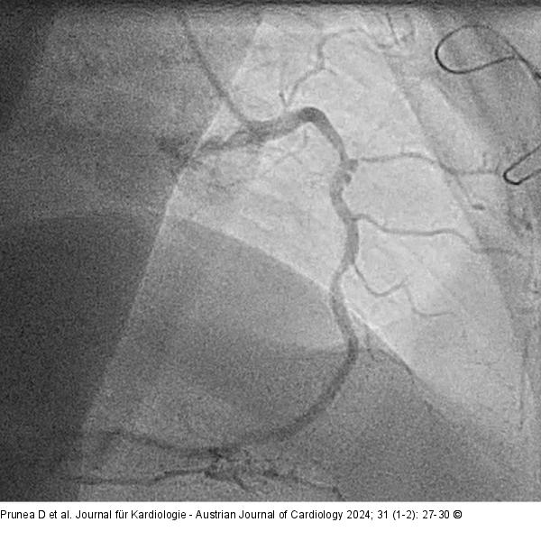 Aneurysma