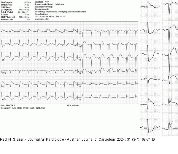 EKG