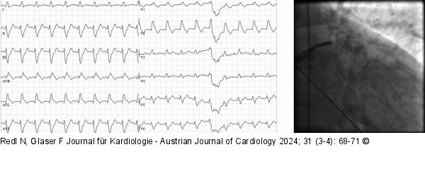 EKG - Angiographie