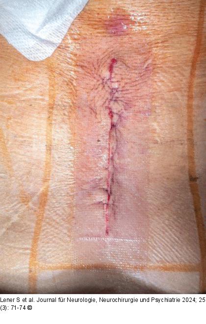 Dermabond + Prineo