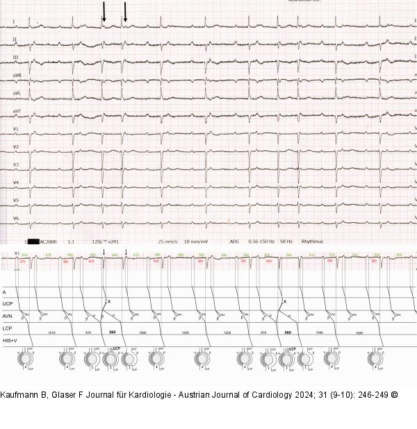 EKG