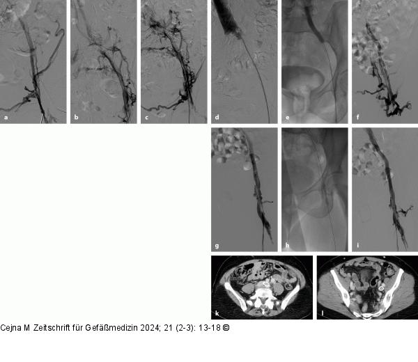 Postthrombotisches Syndrom 