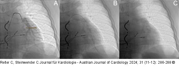 CardioMEMS HF-System - Implantation