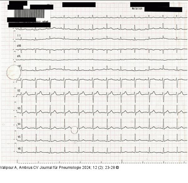 EKG