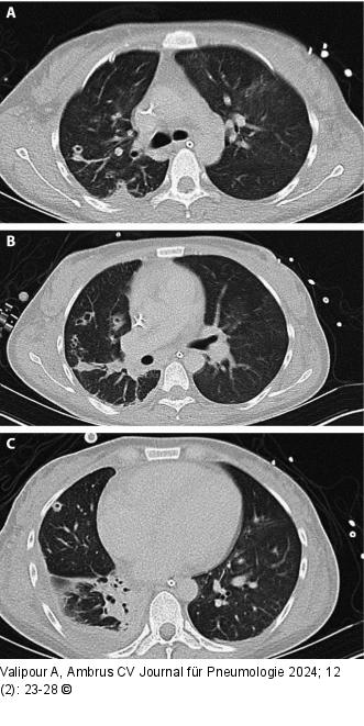 Thorax-CT