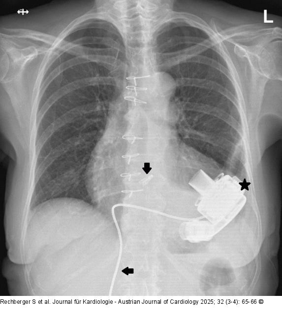 Thorax-Rntgen