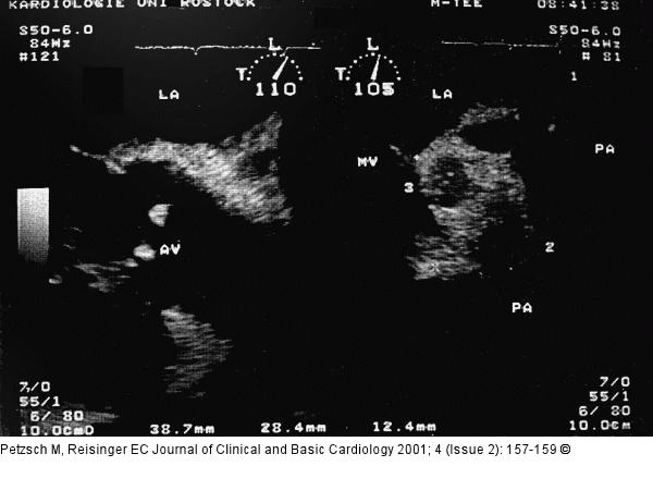 Endokarditis - Diagnose - TEE