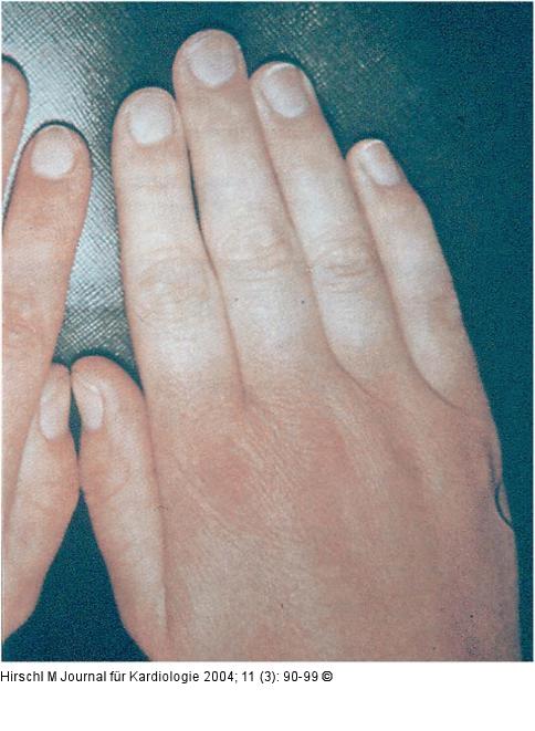 Raynaud-Phnomen