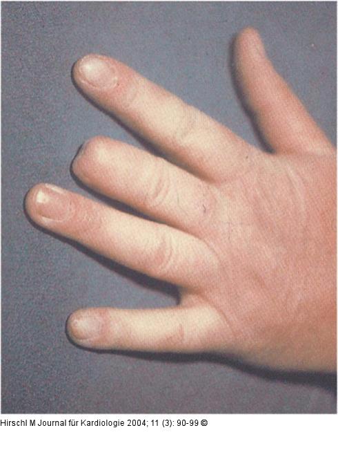 Raynaud-Phnomen