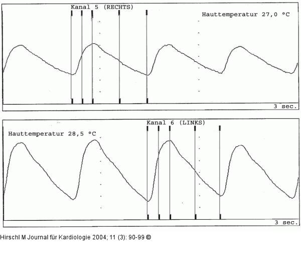Raynaud-Phnomen