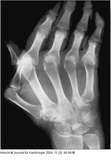 Raynaud-Phnomen