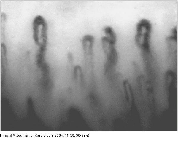 Raynaud-Phnomen