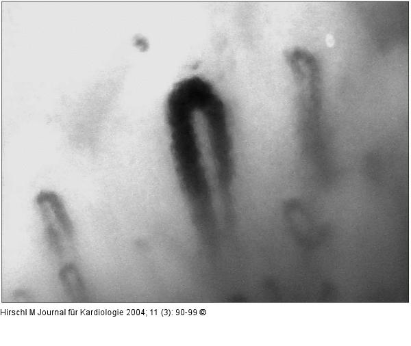 Raynaud-Phnomen