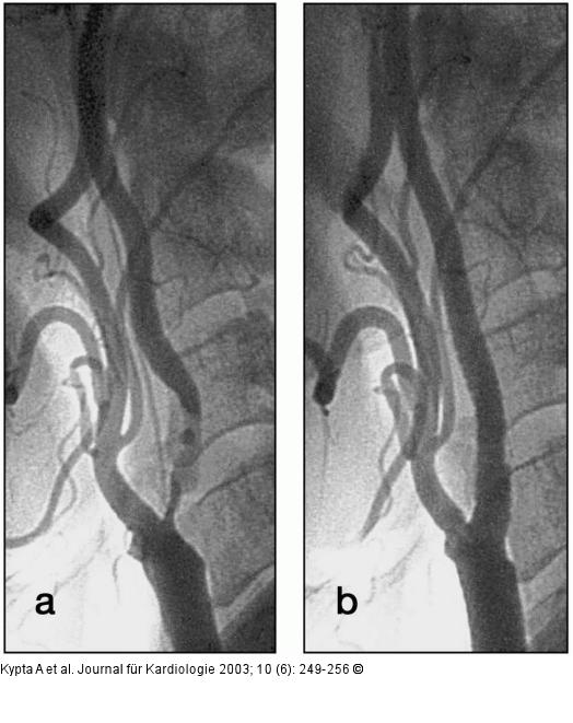 ACI-Stenose - Stent