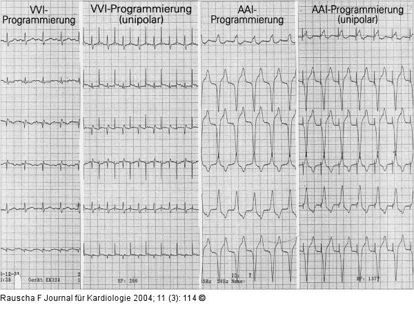 Schrittmacher-EKG - Elektrodenanschluproblem