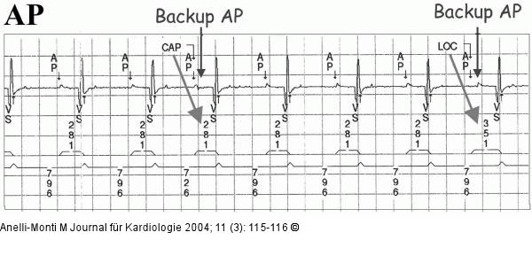 Schrittmacher - AV Conduction
