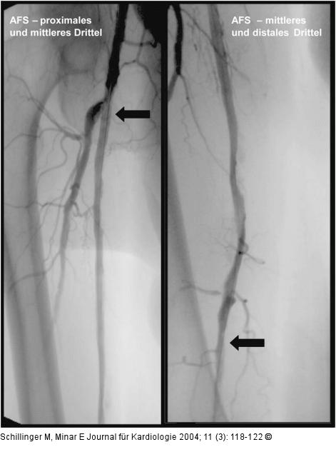 Arteria femoralis superficialis - Stent