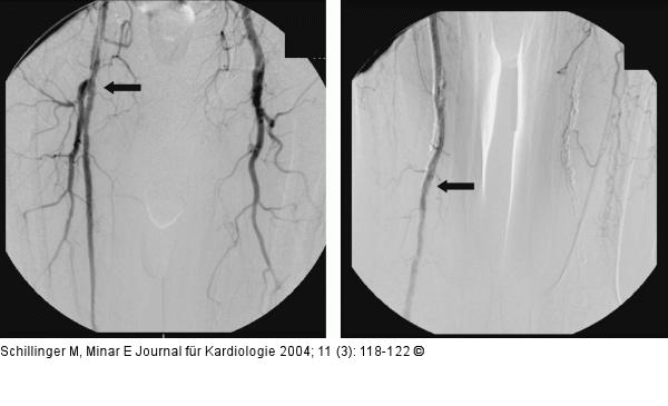 Arteria femoralis superficialis - Stent