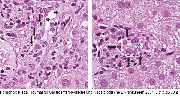 Cholestase