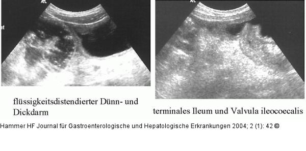 Colitis - Diarrhoe