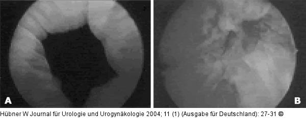 Harninkontinenz - Mann - Chirurgie