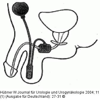 Harninkontinenz - Mann - Chirurgie