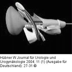 Harninkontinenz - Mann - Chirurgie